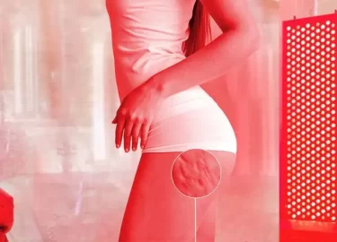 Red Light Therapy for Cellulite and Stretch Marks: Benefits & Treatment