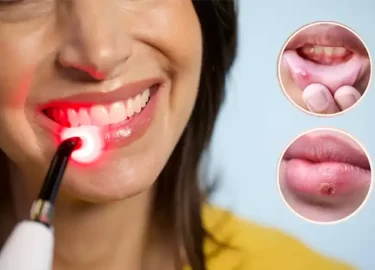 Red Light Therapy for Cold Sores, According to Experts